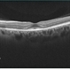 Plaquenil Toxicity